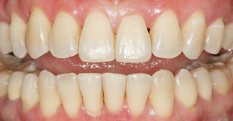 after dental treatment at Broadway Dentistry after dental treatment at Broadway Dentistry