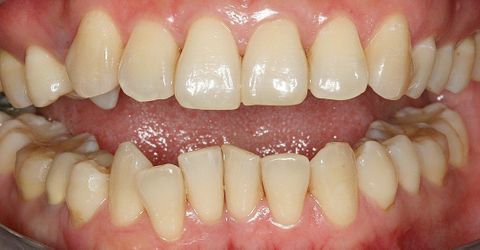 before dental treatment at Broadway Dentistry before dental treatment at Broadway Dentistry