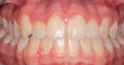 After dental treatment at Broadway Dentistry After dental treatment at Broadway Dentistry