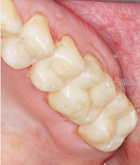 After dental treatment at Broadway Dentistry After dental treatment at Broadway Dentistry