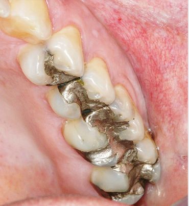 Before dental treatment at Broadway Dentistry Before dental treatment at Broadway Dentistry