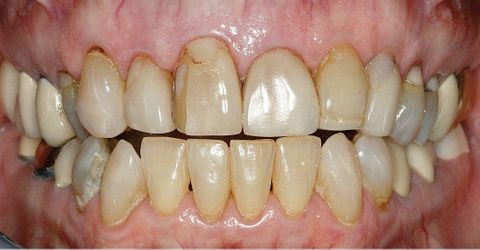 Before dental treatment at Broadway Dentistry Before dental treatment at Broadway Dentistry