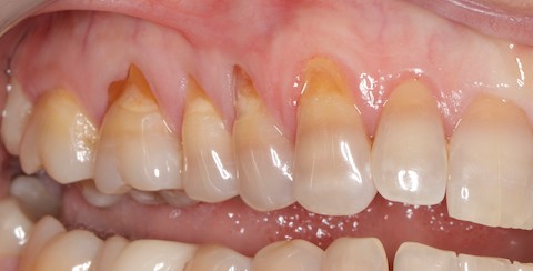 before dental treatment at Broadway Dentistry before dental treatment at Broadway Dentistry