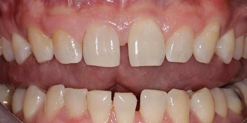 before dental treatment at Broadway Dentistry before dental treatment at Broadway Dentistry