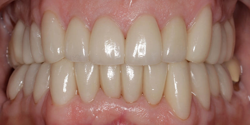 After image of a perfect smile After image of a perfect smile