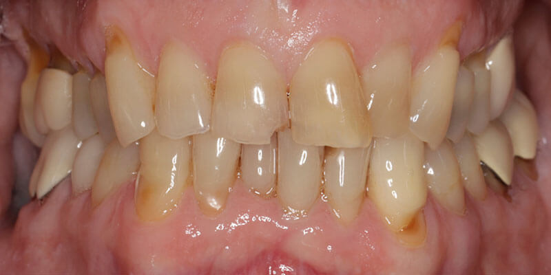 Before dental treatment patient