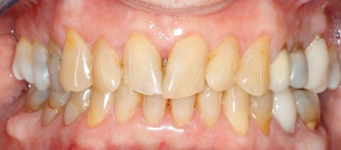 Before dental treatment at Broadway Dentistry Before dental treatment at Broadway Dentistry