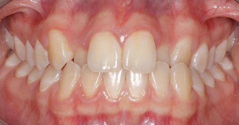 Before dental treatment at Broadway Dentistry Before dental treatment at Broadway Dentistry