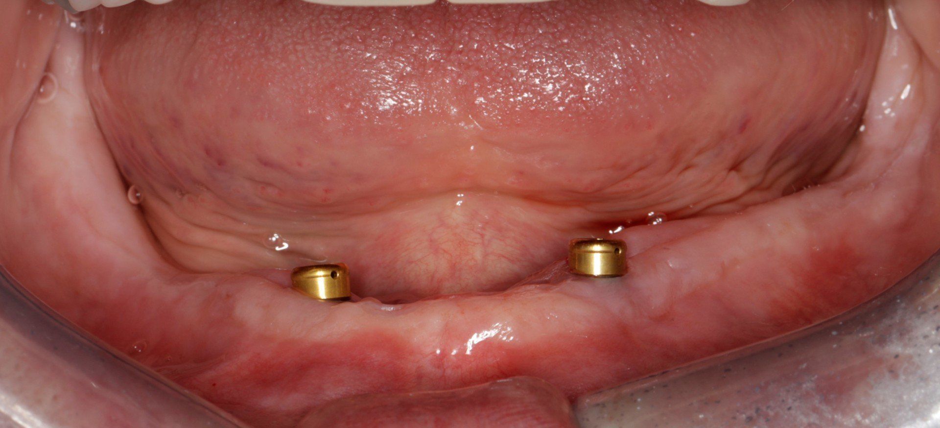 Before dental implant treatment