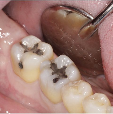 Before dental treatment at Broadway Dentistry Before dental treatment at Broadway Dentistry