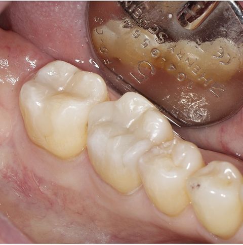 After dental treatment at Broadway Dentistry After dental treatment at Broadway Dentistry