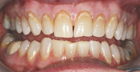Before dental treatment at Broadway Dentistry Before dental treatment at Broadway Dentistry