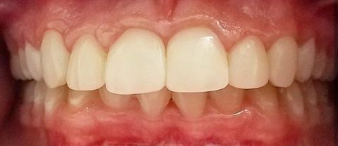 after dental treatment at Broadway Dentistry after dental treatment at Broadway Dentistry